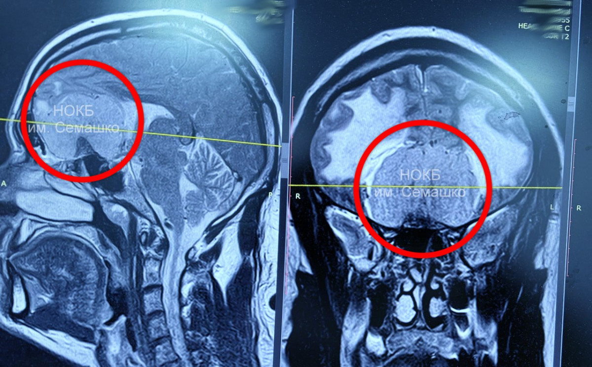 Нейрохирурги удалили гигантскую опухоль из головы нижегородца
